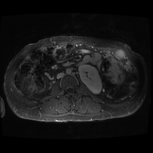 Acinar cell carcinoma of the pancreas (Radiopaedia 75442-86668 D 10).jpg