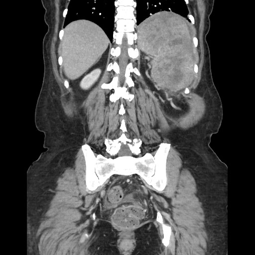 Acinar cell carcinoma of the pancreas (Radiopaedia 75442-86669 Coronal C+ portal venous phase 97).jpg