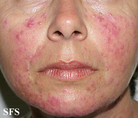 File:Acne Rosacea (Dermatology Atlas 10).jpg