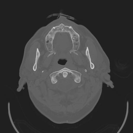 File:Acoustic schwannoma (Radiopaedia 29488-29982 AXIAL BONE THICK non-contrast 1).jpg