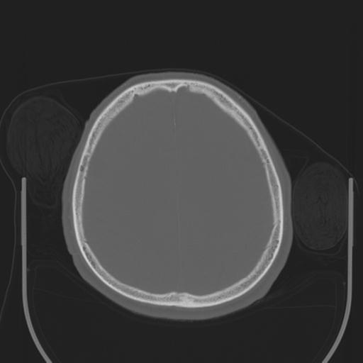 File:Acoustic schwannoma (Radiopaedia 29488-29982 AXIAL BONE THICK non-contrast 37).jpg