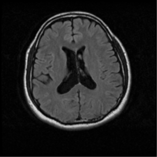 File:Acoustic schwannoma (Radiopaedia 33045-34060 Axial FLAIR 13).png