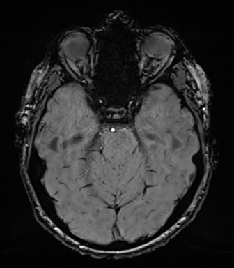 Acoustic schwannoma (Radiopaedia 50846-56358 Axial SWI 32).png