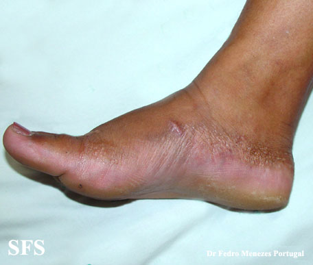 Acrokeratoelastoidosis (Dermatology Atlas 1).jpg