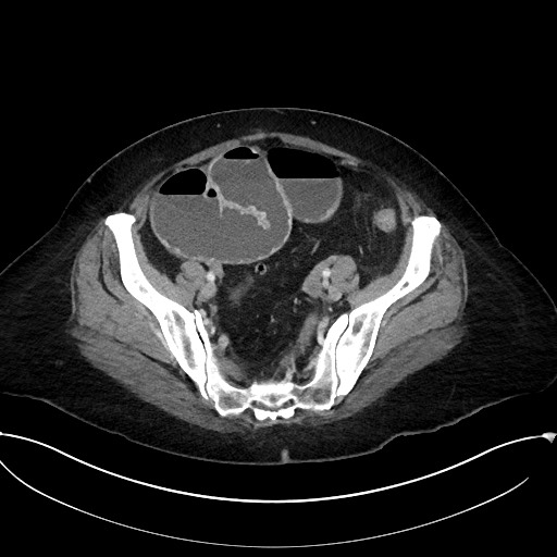 Active Crohn disease (Radiopaedia 59394-66750 Axial C+ portal venous phase 57).jpg
