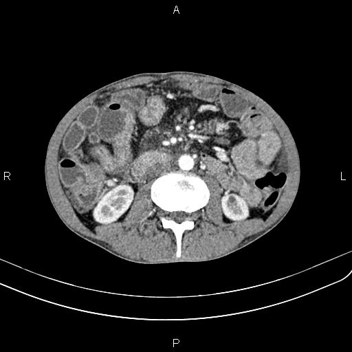 Active crohn disease (Radiopaedia 87133-103397 Axial C+ arterial phase 53).jpg