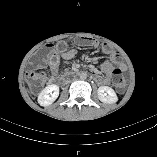 Active crohn disease (Radiopaedia 87133-103397 Axial C+ delayed 26).jpg