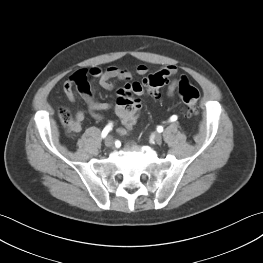 File:Active diverticular hemorrhage (Radiopaedia 39415-41725 Axial C+ arterial phase 49).png