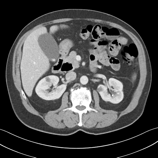 File:Active diverticular hemorrhage (Radiopaedia 39415-41725 Axial C+ portal venous phase 24).png