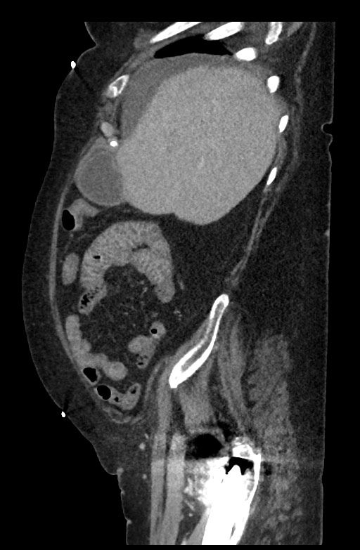 Active renal extravasation with large subcapsular and retroperitoneal hemorrhage (Radiopaedia 60975-68796 Sagittal C+ portal venous phase 173).jpg