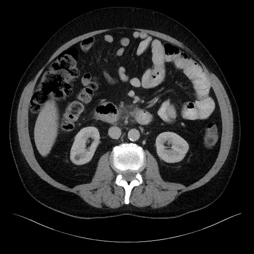 File:Acute-on-chronic pancreatitis (Radiopaedia 67286-76656 Axial C+ portal venous phase 37).jpg