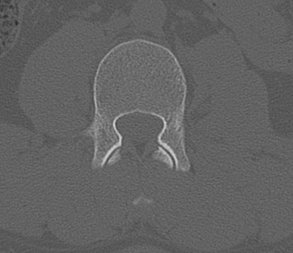 File:Acute L1 burst compression fracture (Radiopaedia 34430-35755 Axial bone window 45).png