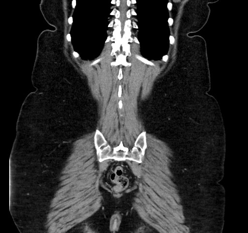 Acute appendicitis, heterotaxy syndrome (Radiopaedia 66884-76202 Coronal C+ portal venous phase 107).jpg
