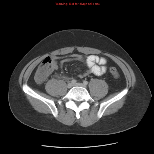 Acute appendicitis (Radiopaedia 10498-10973 Axial C+ portal venous phase 19).jpg