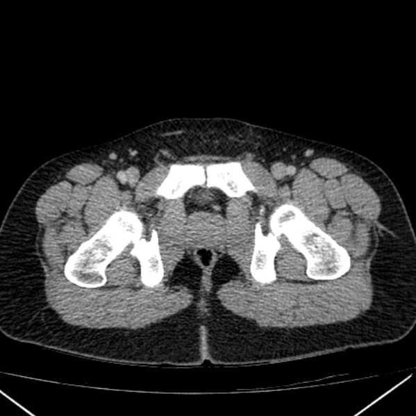 Acute appendicitis (Radiopaedia 38255-40270 Axial C+ portal venous phase 113).jpg