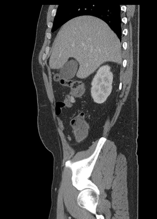 Acute appendicitis (Radiopaedia 48511-53463 Sagittal C+ portal venous phase 40).jpg