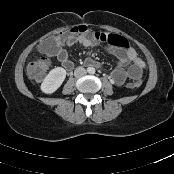 File:Acute appendicitis (Radiopaedia 48792-53822 Axial C+ portal venous phase 64).jpg
