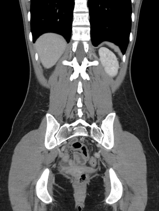 Acute appendicitis (Radiopaedia 62608-70901 Coronal C+ portal venous phase 45).jpg