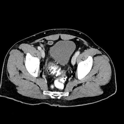 Acute appendicitis (Radiopaedia 77016-88960 Axial C+ portal venous phase 125).jpg