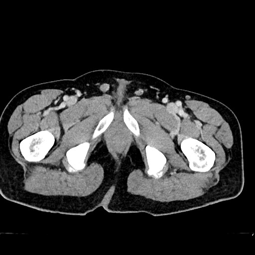 File:Acute appendicitis (Radiopaedia 77016-88960 Axial C+ portal venous phase 151).jpg