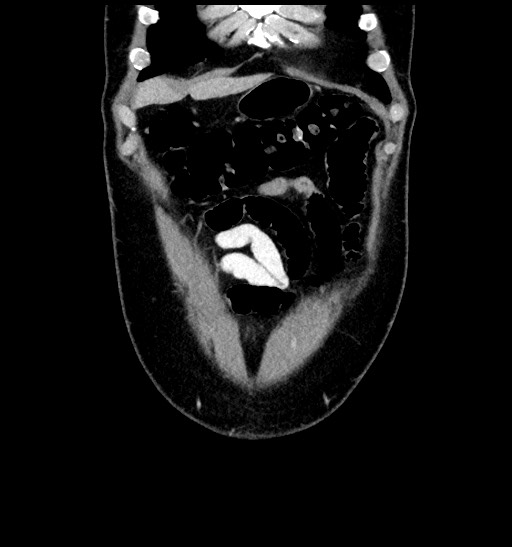 File:Acute appendicitis (Radiopaedia 77016-88960 Coronal C+ portal venous phase 23).jpg