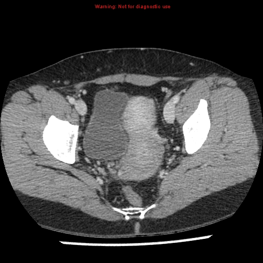 Acute appendicitis (Radiopaedia 7966-8812 C+ portal venous phase 49).jpg