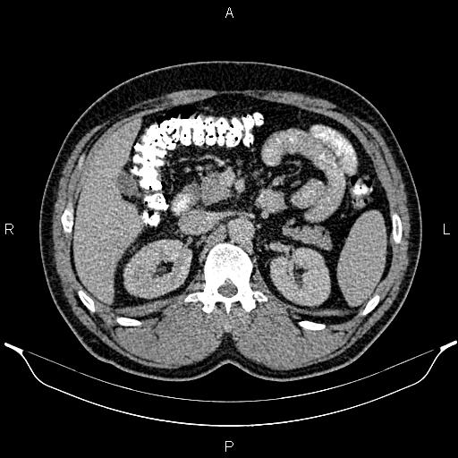 Acute appendicitis (Radiopaedia 84780-100240 Axial C+ portal venous phase 37).jpg
