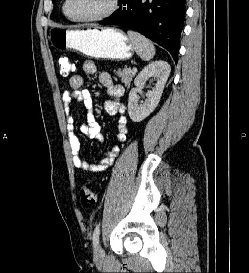 File:Acute appendicitis (Radiopaedia 84780-100240 Sagittal C+ portal venous phase 76).jpg