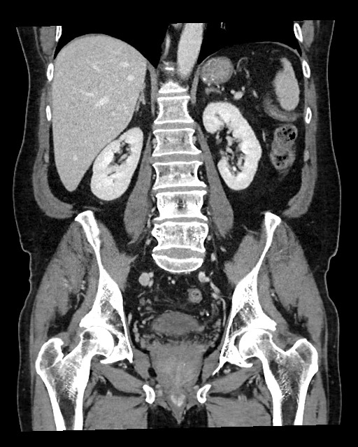 Acute appendicitis - large appendicoliths (Radiopaedia 61805-69820 Coronal C+ portal venous phase 85).jpg