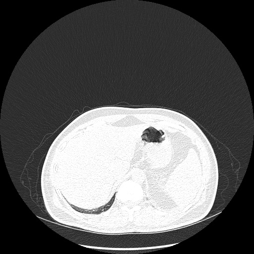 File:Acute appendicitis and COVID 19 pneumonia (Radiopaedia 76604-88380 Axial lung window 53).jpg