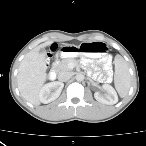 File:Acute appendicitis with CT arrowhead sign (Radiopaedia 21474-21411 Axial C+ portal venous phase 12).jpg