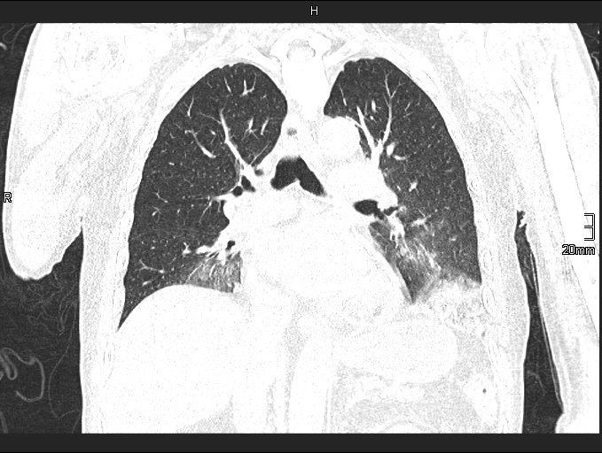 Acute aspiration pneumonitis (Radiopaedia 55642-62166 Coronal lung window 56).jpg
