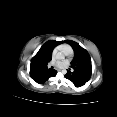 Acute calculous cholecystitis in patient with osteopetrosis (Radiopaedia 77871-90159 Axial C+ portal venous phase 4).jpg