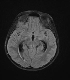 File:Acute cerebellar ataxia (Radiopaedia 61487-69446 Axial FLAIR 9).jpg