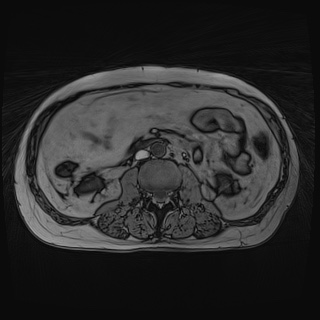 File:Acute cholecystitis (Radiopaedia 72392-82923 Axial T1 out-of-phase 78).jpg