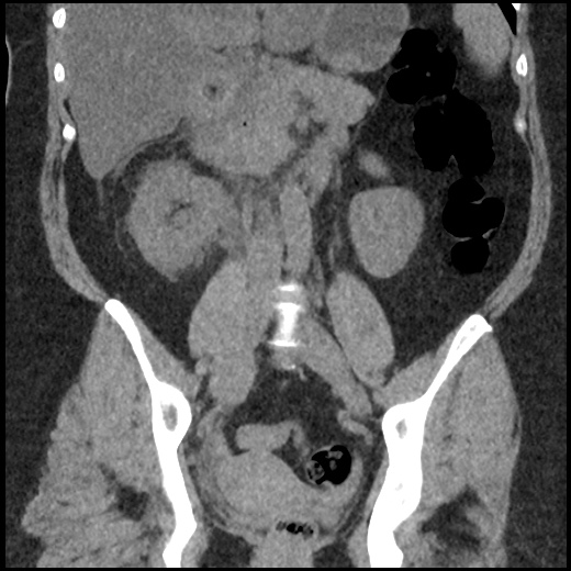 Acute cholecystitis and ureteric colic (Radiopaedia 42330-45444 Coronal prone 58).jpg