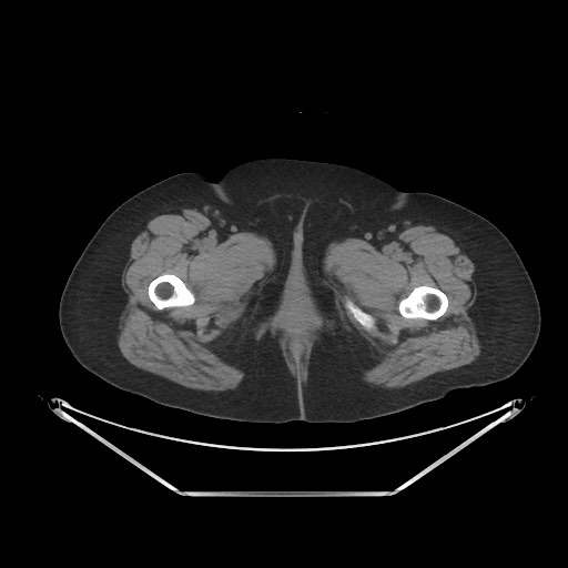 File:Acute cholecystitis with tensile fundus sign (Radiopaedia 71394-81723 Axial non-contrast 133).jpg