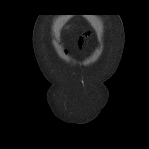 Acute cholecystitis with tensile fundus sign (Radiopaedia 71394-81723 Coronal non-contrast 21).jpg