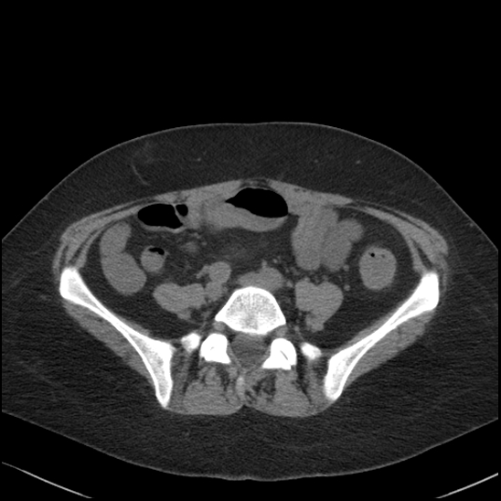 Acute colonic hemorrhage in ulcerative colitis (Radiopaedia 77415-89538 Axial non-contrast 92).jpg