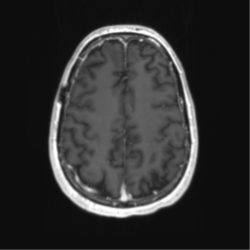 Acute disseminated encephalomyelitis (ADEM) (Radiopaedia 65319-74350 Axial T1 C+ 48).png