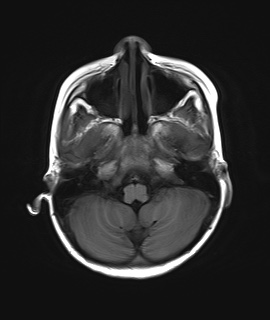 File:Acute disseminating encephalomyelitis with bilateral optic neuritis (Radiopaedia 79676-92886 Axial T1 5).jpg
