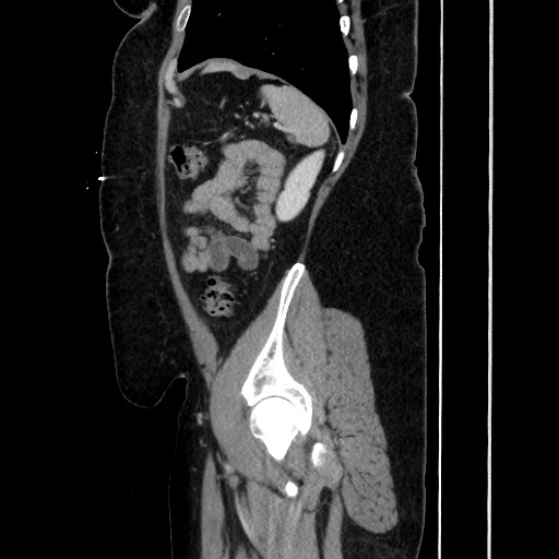 Acute diverticulitis - transverse colon (Radiopaedia 87063-103327 Sagittal C+ portal venous phase 170).jpg