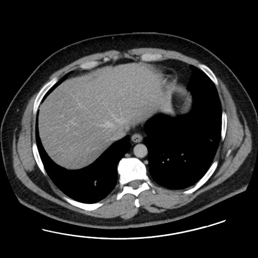 File:Acute diverticulitis with localized perforation (Radiopaedia 41296-44113 Axial C+ portal venous phase 12).jpg