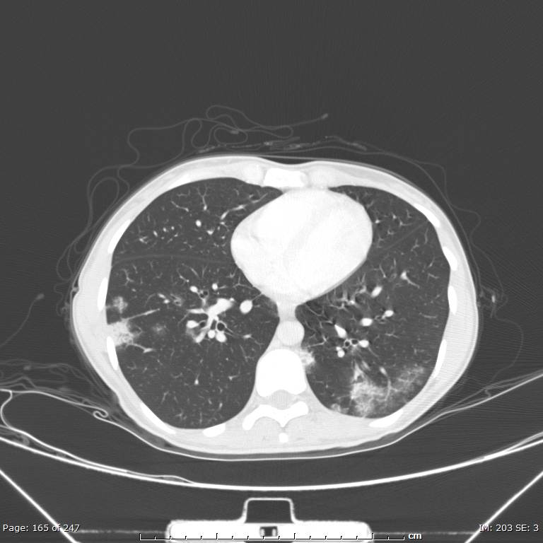 Acute eosinophilic pneumonia (Radiopaedia 48211-53073 Axial lung window 59).jpg