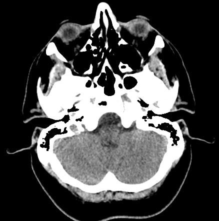 Acute internal carotid artery dissection (Radiopaedia 53541-59558 Axial non-contrast 11).jpg