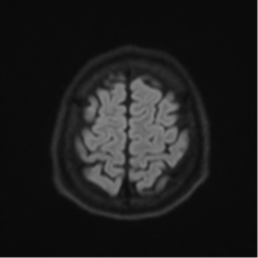 Acute left middle cerebral artery territory infarct with clot retrieval (Radiopaedia 47732-52433 Axial DWI 56).png