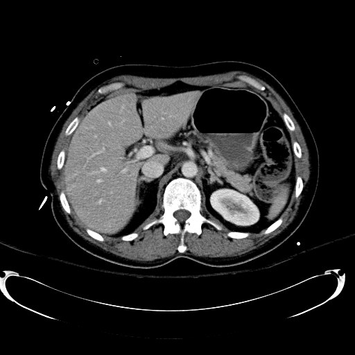File:Acute myocardial infarction in CT (Radiopaedia 39947-42415 Axial C+ portal venous phase 37).jpg
