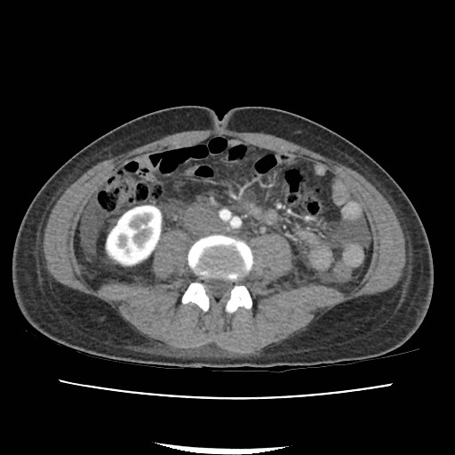 Acute myocarditis (Radiopaedia 55988-62613 Axial C+ portal venous phase 44).jpg