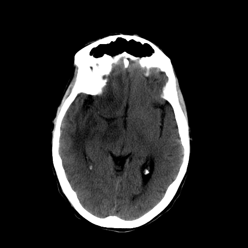 File:Acute necrotizing toxoplasma encephalitis (Radiopaedia 10683-11150 B 19).jpg