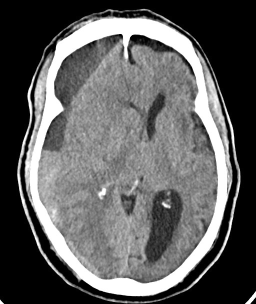 Acute on chronic subdural hematoma (Radiopaedia 78346-90966 Axial non-contrast 32).jpg